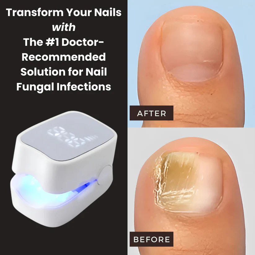 Nail Fungus Treatment Solutions