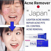 Lion Pair Acne Cream – Targeted Care for Clearer Skin